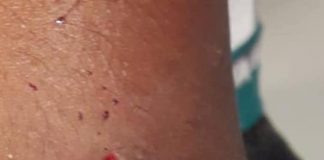 Leshon serio mordé di kachó